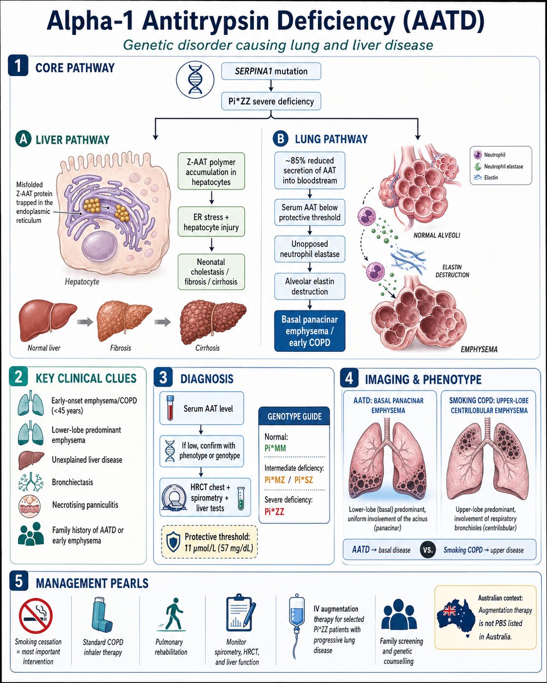 Alpha-1 Antitrypsin Deficiency infographic — SERPINA1 / PI*ZZ pathway, liver and lung pathways, key clinical clues, diagnosis algorithm, basal panacinar vs upper-lobe centrilobular emphysema, and management pearls