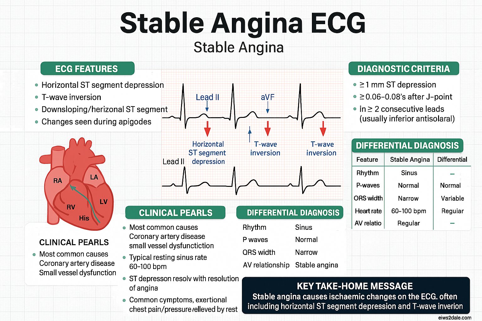 Stable Angina ECG infographic — ECG features, diagnostic criteria, mechanism, clinical pearls, differential diagnosis, and key take-home message